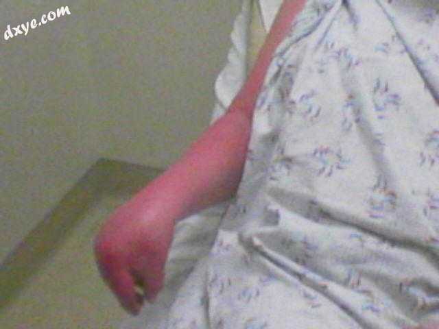 Severe CRPS of right arm.jpg