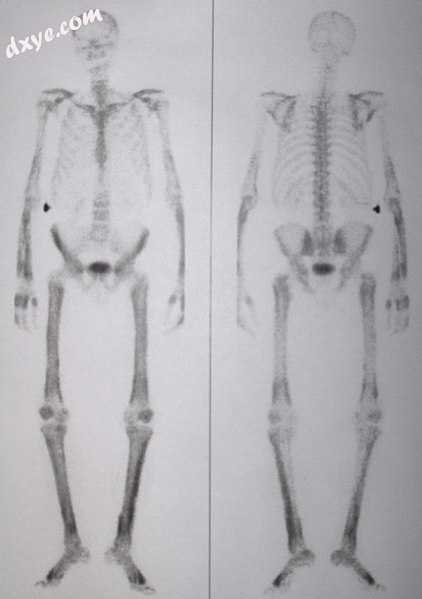 Bonescan of a person with 肥大性骨关节病.jpg