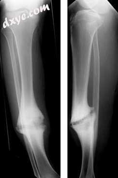 Hypertrophic 骨折不愈合 of the tibia.jpg