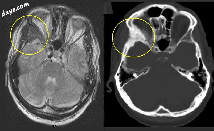 Fibrous dysplasia of the right zygomatic bone (left in the image). Corresponding.jpg