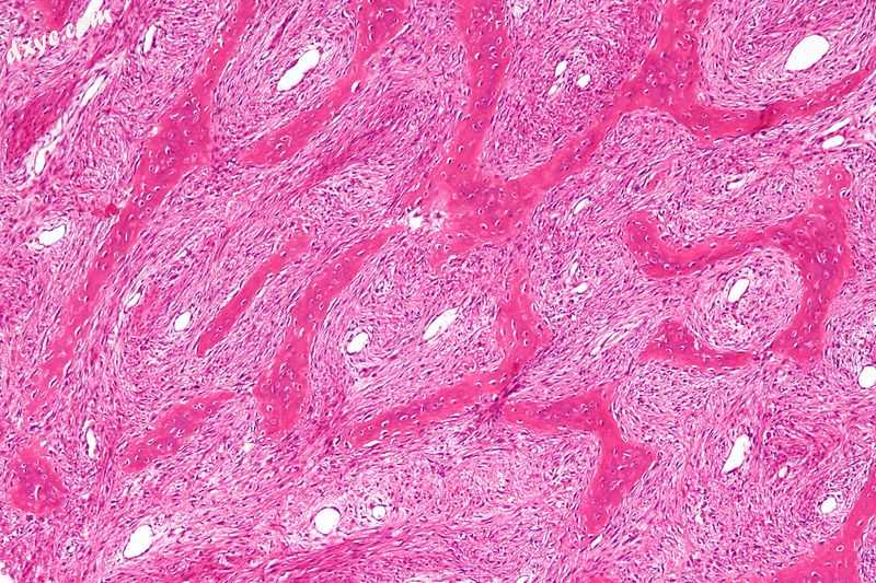 Micrograph showing fibrous dysplasia with the characteristic thin, irregular (Ch.jpg