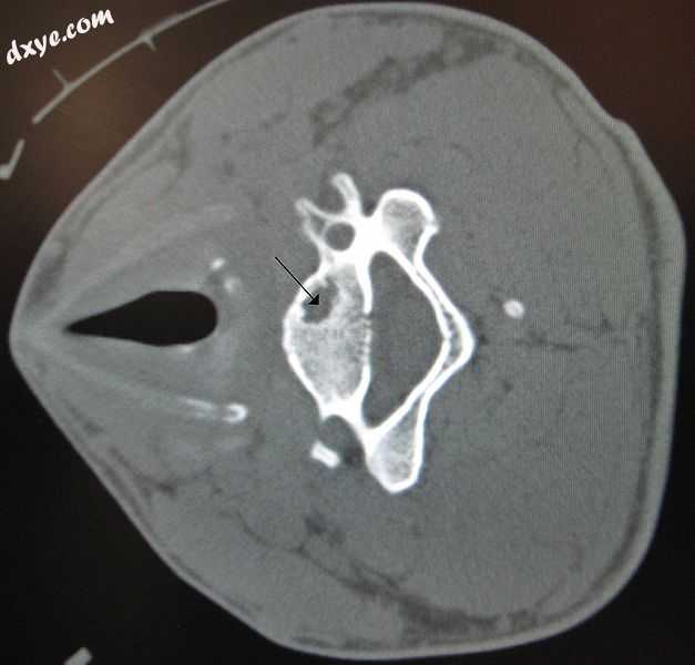 A bone cyst in the vertebra of the neck as seen on CT.jpg