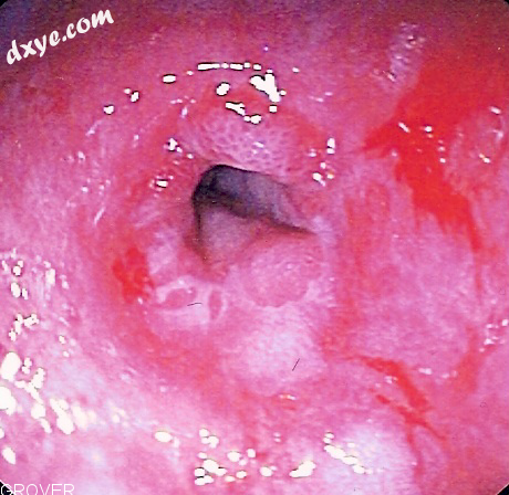 Endoscopic image of a non-cancerous peptic stricture, or narrowing of the esopha.png