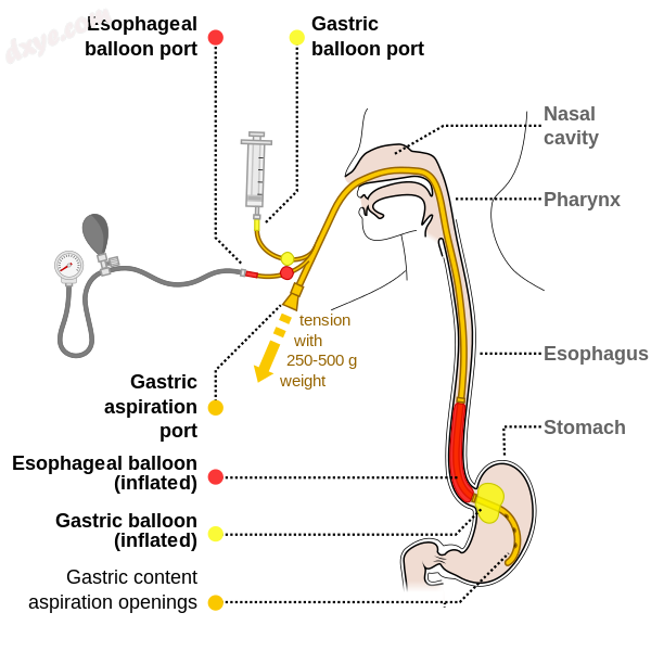 The Blakemore esophageal balloon used for stopping esophageal bleeds if other me.png