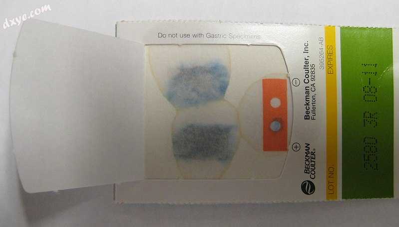 A positive fecal occult blood test.jpg