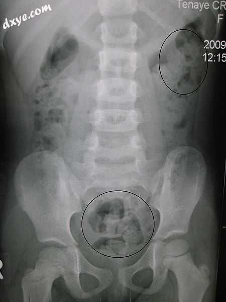 Constipation in a young child seen on X-ray. Circles represent areas of fecal ma.jpg