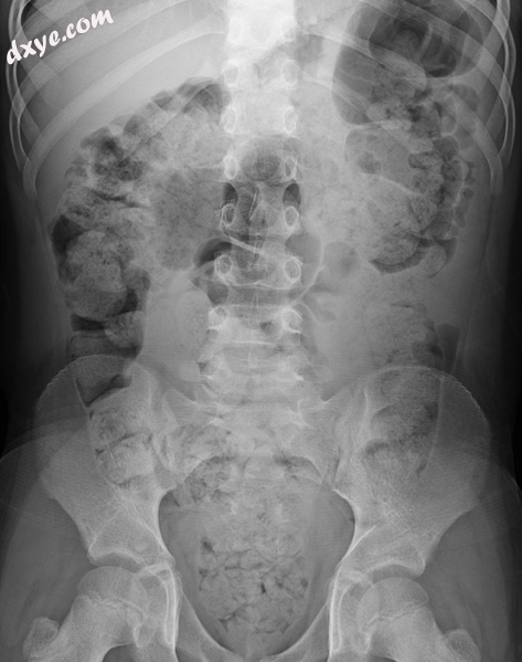 Significant constipation in the plain X-ray of an 8-year-old.png