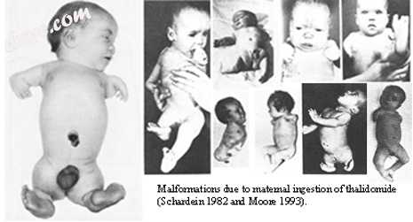 Cases of severe thalidomide-induced phocomelia..jpg