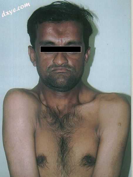 Facial and forehead changes along with increased mobility of the shoulder girdles.jpg