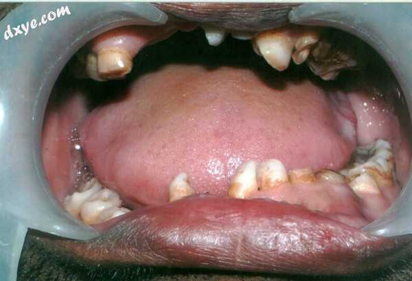 Mouth showing many over-retained deciduous teeth and some missing teeth..jpg