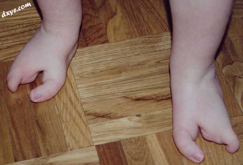 少指畸形 as a result of ectrodactyly on the feet of a one-year-old child.jpg