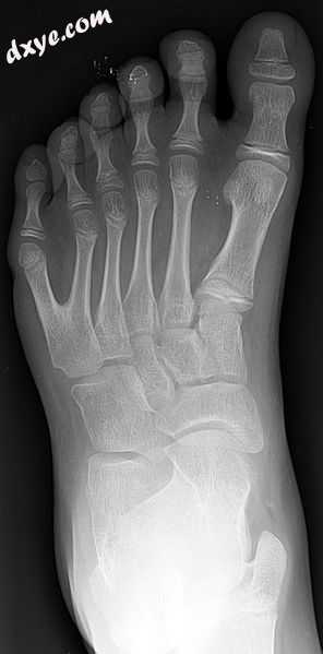 Left foot with postaxial 多指趾畸形 of 5th ray.jpg