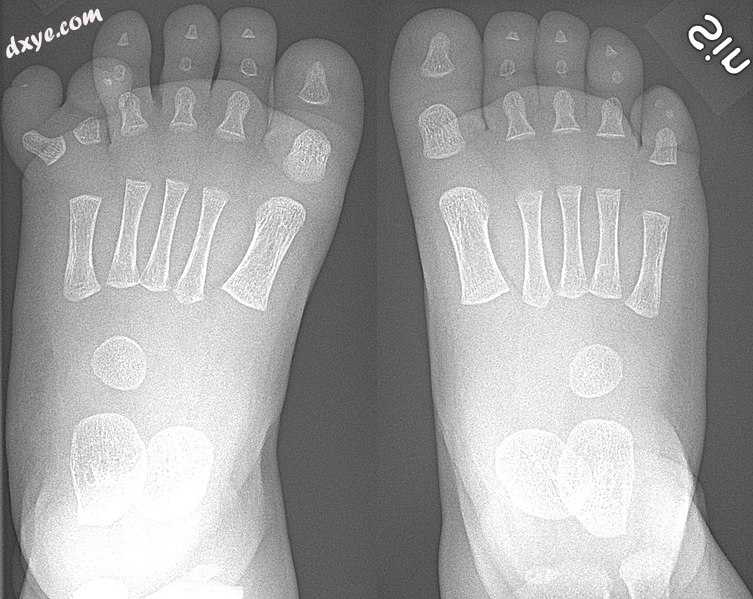 Right-sided duplication of the right little toe in an 8.5 months old male, with .jpg
