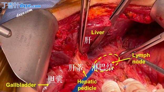 复发性卵巢癌腹腔干淋巴结切除术及解剖