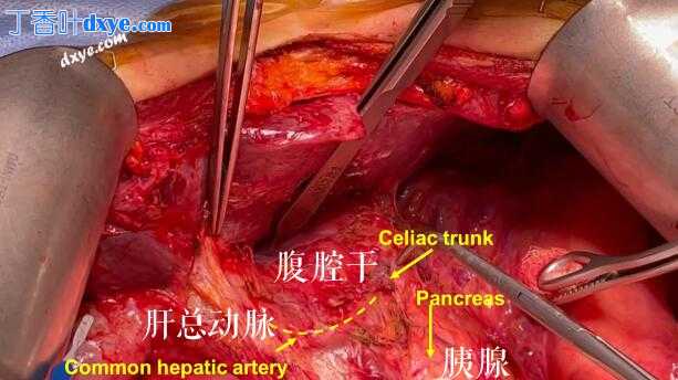 复发性卵巢癌腹腔干淋巴结切除术及解剖