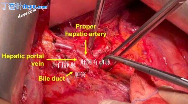 复发性卵巢癌腹腔干淋巴结切除术及解剖