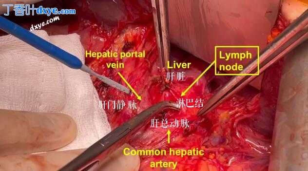 复发性卵巢癌腹腔干淋巴结切除术及解剖