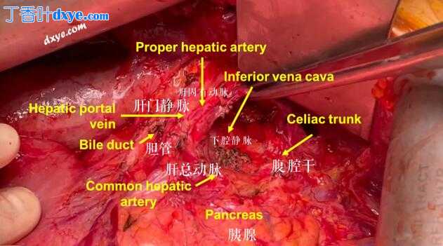 复发性卵巢癌腹腔干淋巴结切除术及解剖