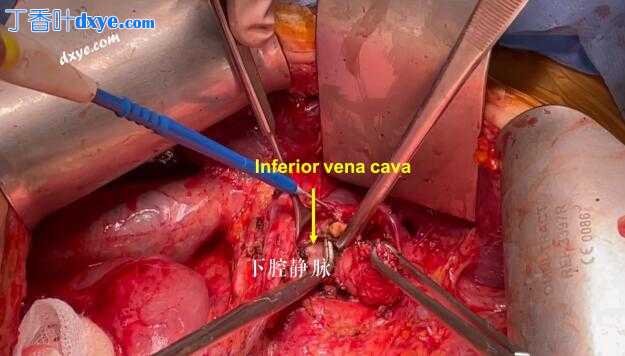 复发性卵巢癌腹腔干淋巴结切除术及解剖