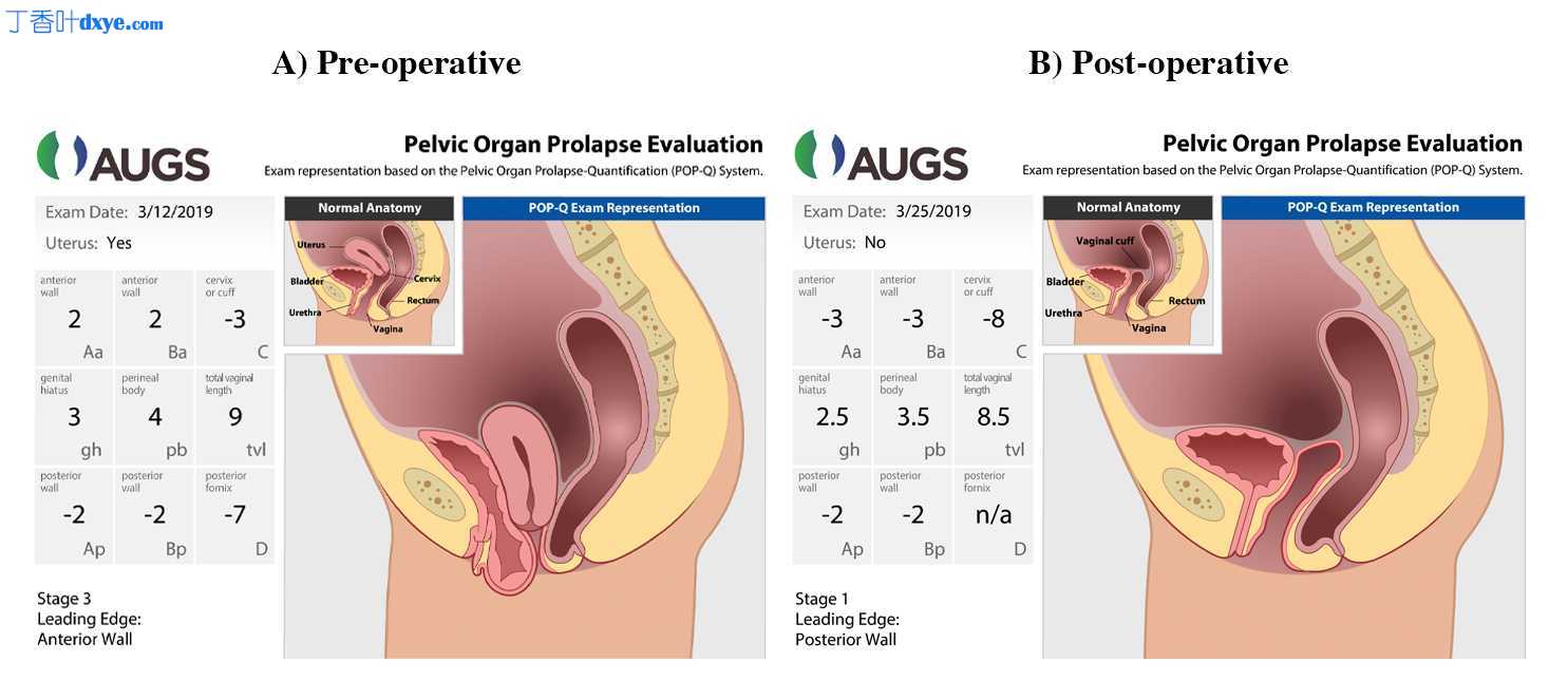 阴道子宫切除术、子宫骶韧带悬吊术、前路修复术和会阴修复术