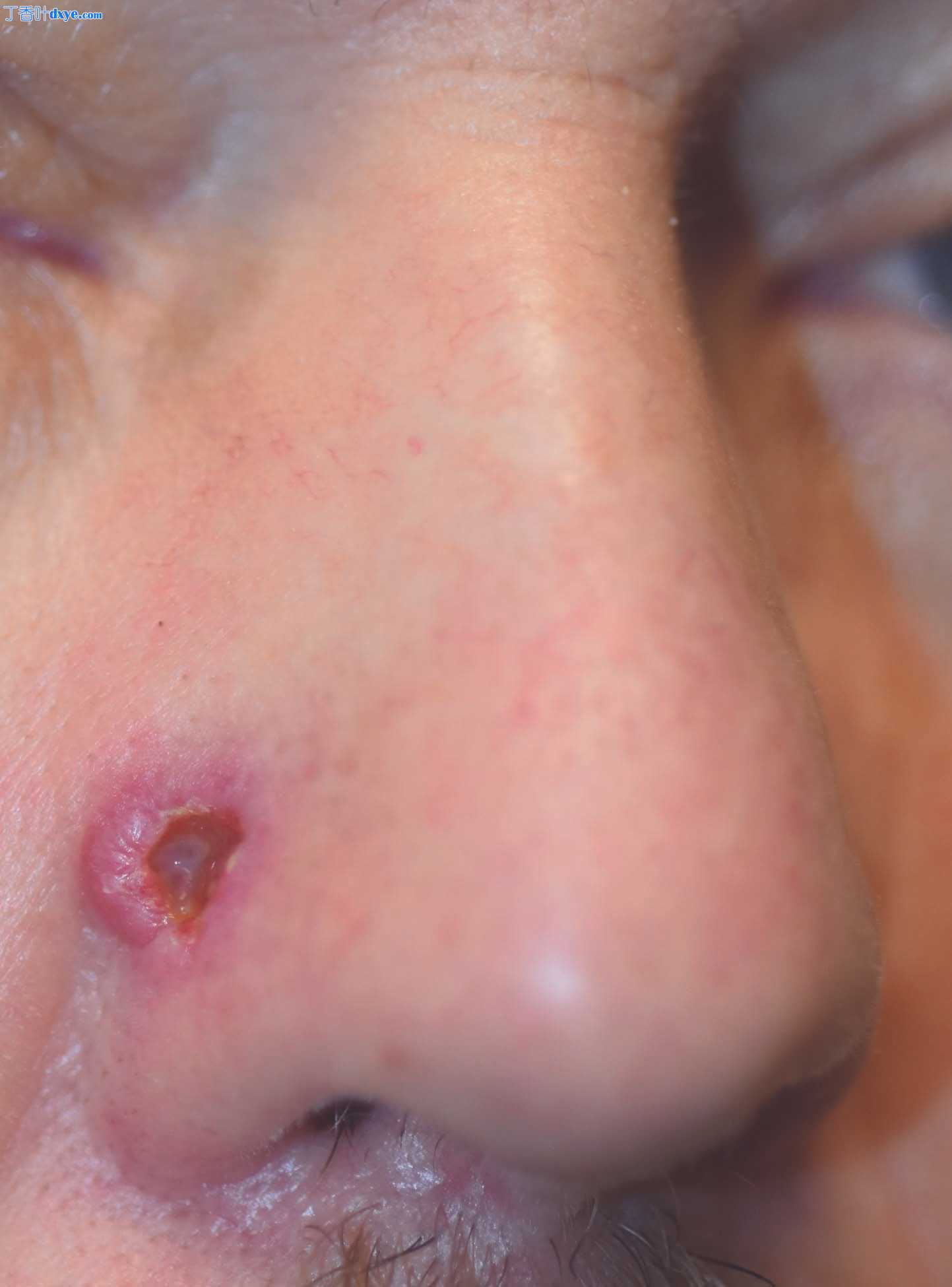 Keystone皮瓣重建下唇基底细胞癌切除术