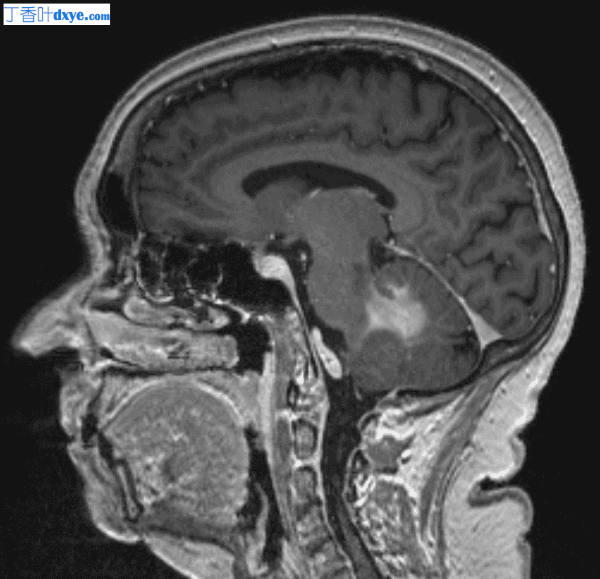 疑似小脑淋巴瘤的脑活检