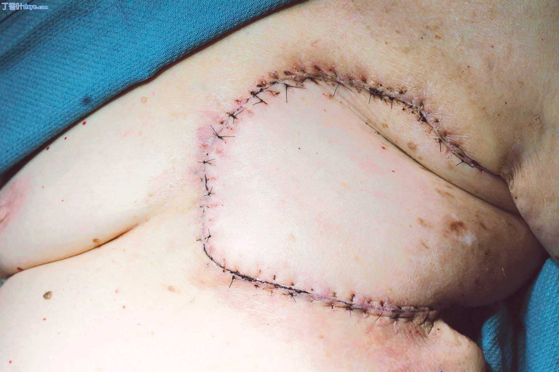 左侧乳房切除术伤口闭合与左侧背阔肌肌肉皮肤局部皮瓣