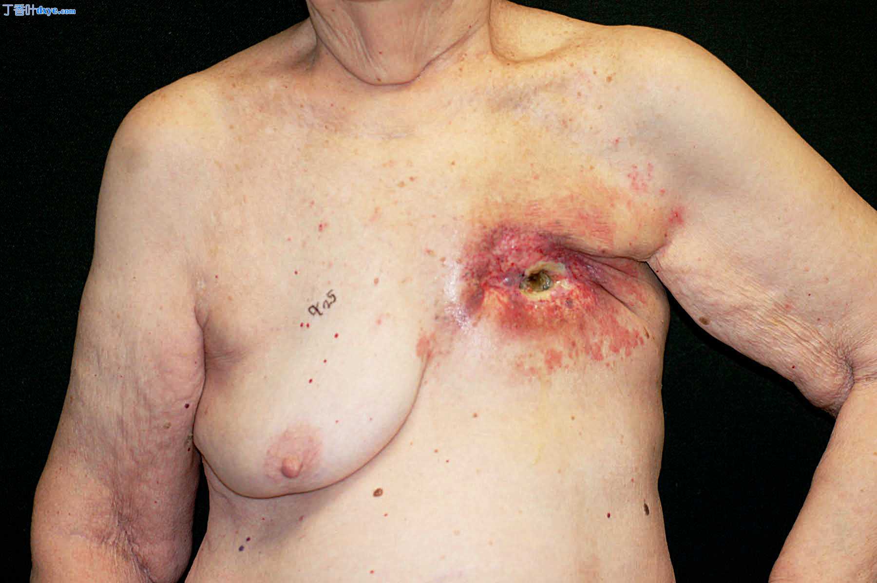 左侧乳房切除术伤口闭合与左侧背阔肌肌肉皮肤局部皮瓣