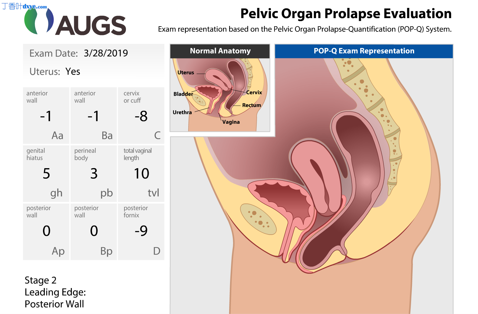 针对直肠前突的特定部位后部阴道成形术和会阴成形术