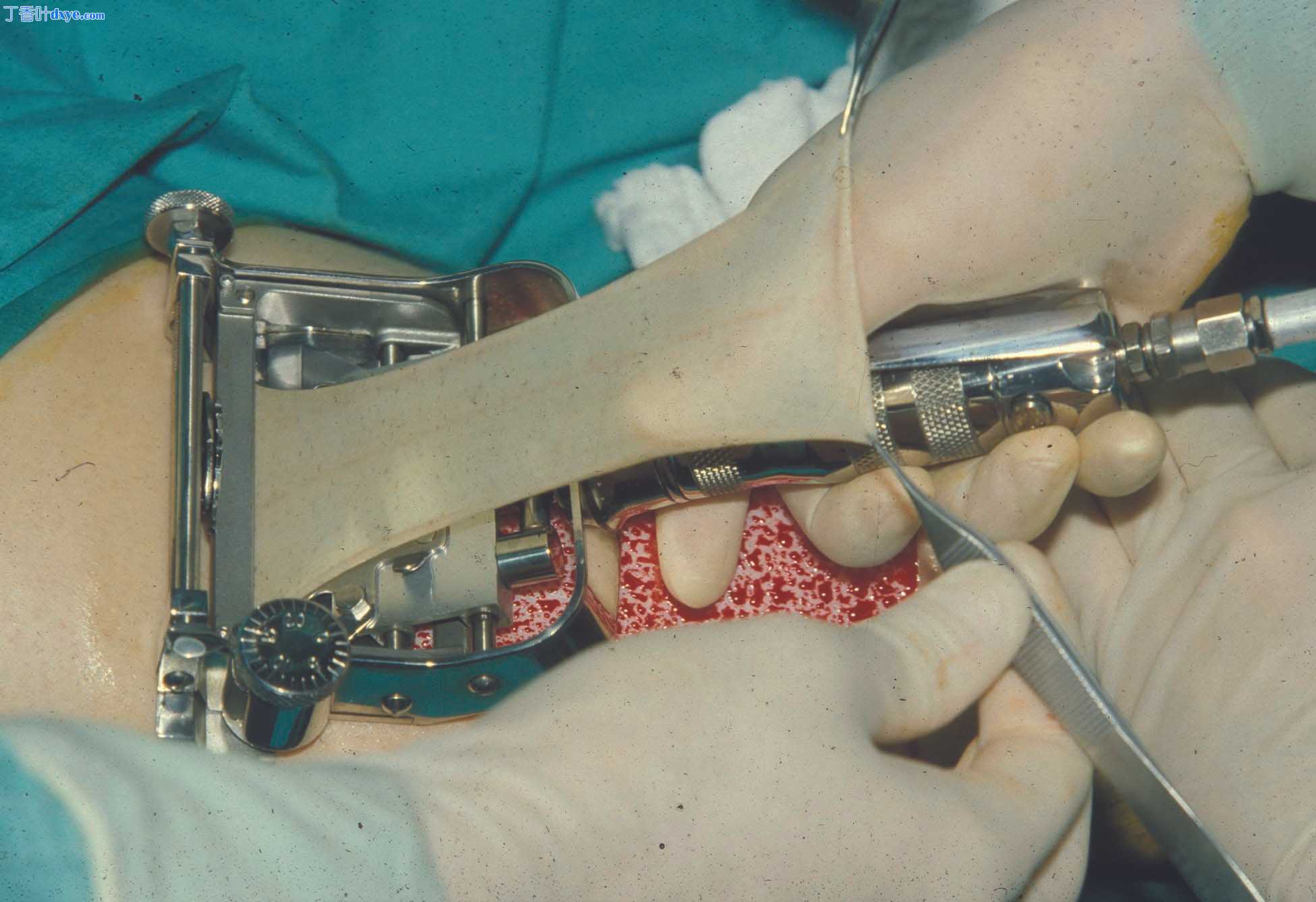右前臂鳞状细胞癌切除术伴大腿中厚皮片移植
