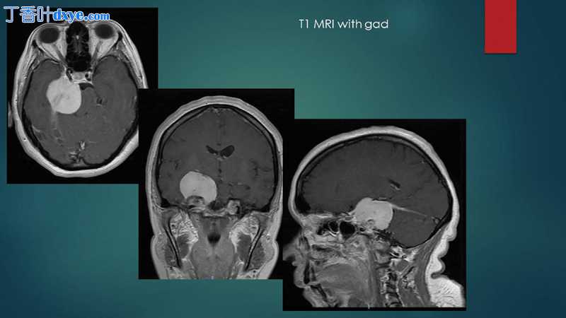 岩斜区脑膜瘤切除术的分期方法