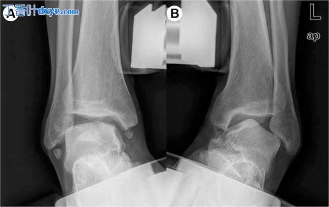 踝关节韧带重建术后 5 个月的患者随访