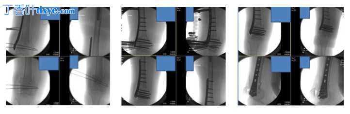 用于股骨远端骨折修复的微创稳定系统 (LISS)
