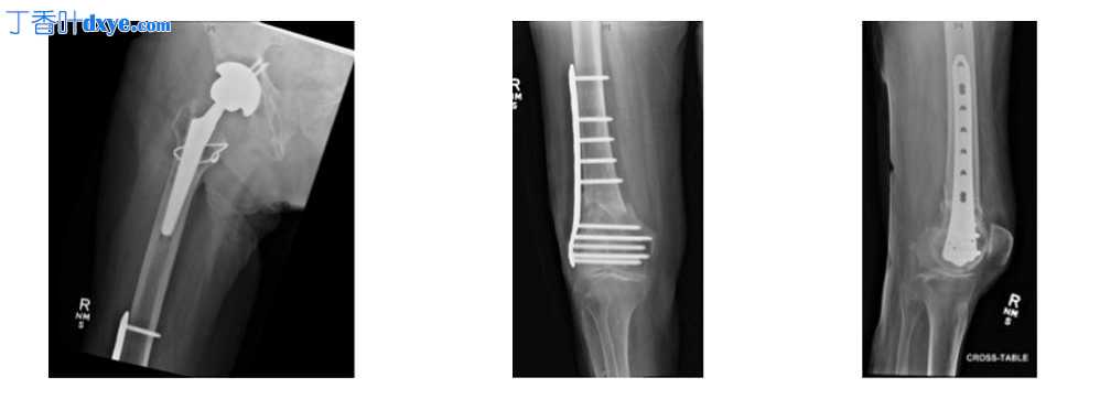 用于股骨远端骨折修复的微创稳定系统 (LISS)