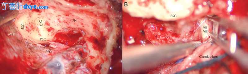 脑膜瘤联合岩骨入路