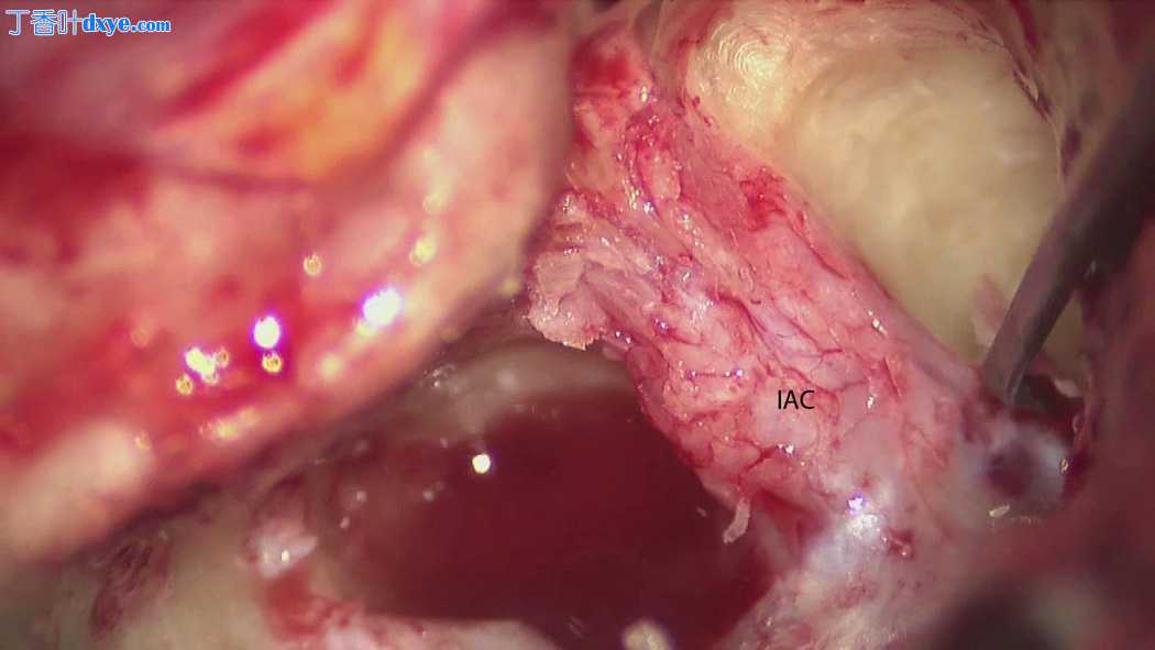 经迷路入路 - 手术视频 