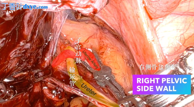 腹腔镜牛头钳用于临时子宫血管结扎