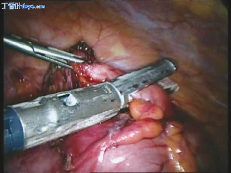 Milan技术的腹腔镜阑尾切除术