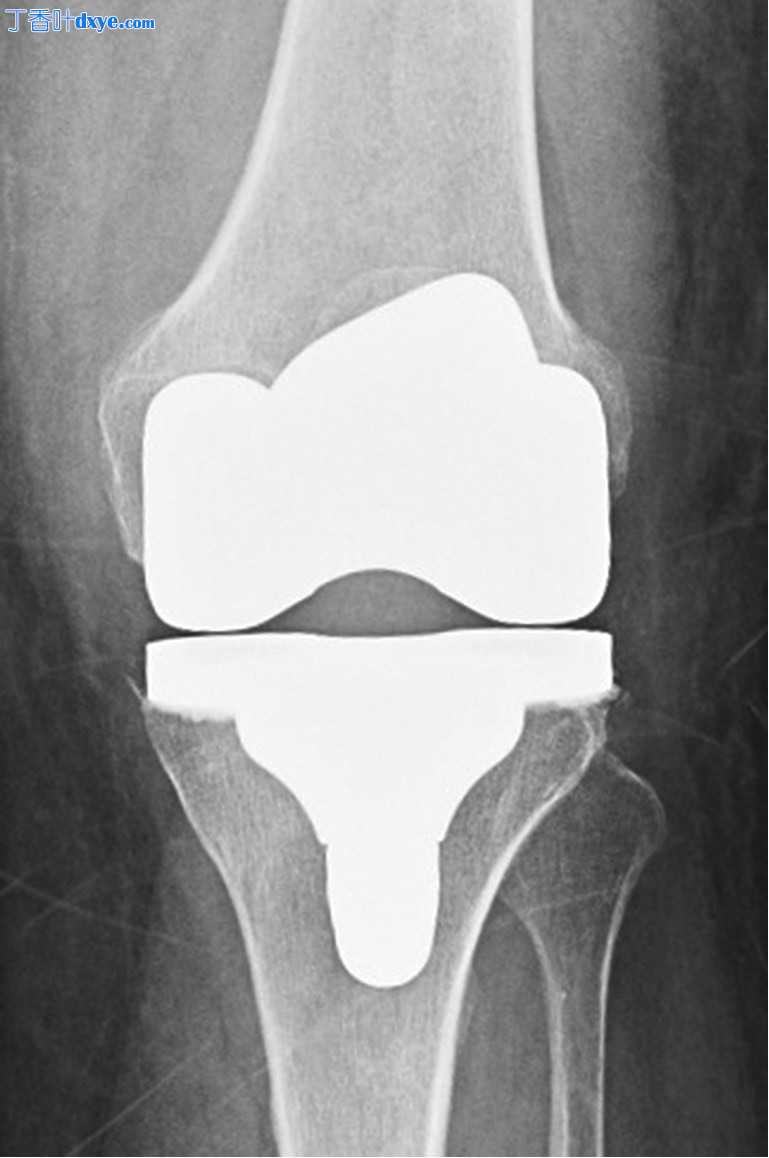 膝关节手术-移动式全膝关节置换术