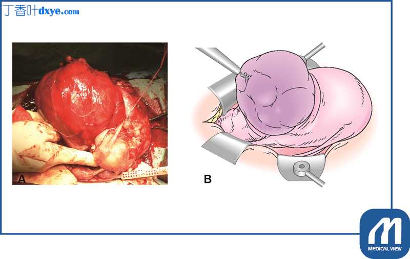 子宫肌瘤切除术