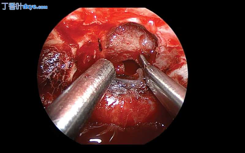 内窥镜下经鼻平面-经鞍结核入路