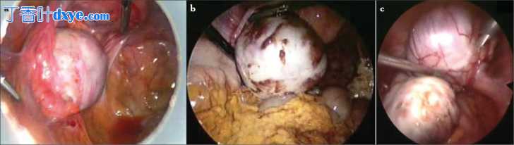 大左侧子宫内膜异位症切除术令人惊喜
