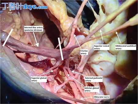 髂内动脉的解剖结构及其对围产期和盆腔出血的教育性解剖