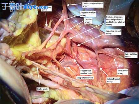 髂内动脉的解剖结构及其对围产期和盆腔出血的教育性解剖