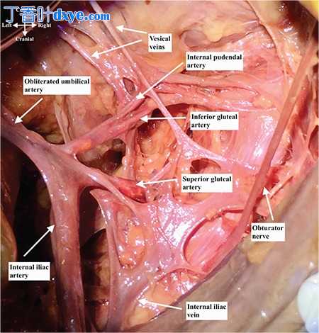 髂内动脉的解剖结构及其对围产期和盆腔出血的教育性解剖