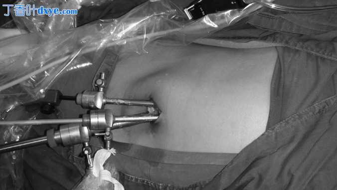 单切口腹腔镜联合胆囊切除术和阑尾切除术