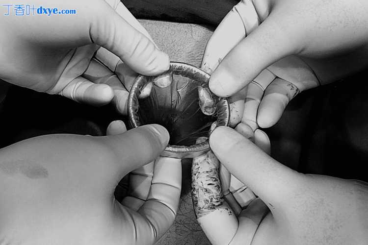通过脐切口使用手术手套端口进行腹腔镜阑尾切除术：一项单中心回顾性研究