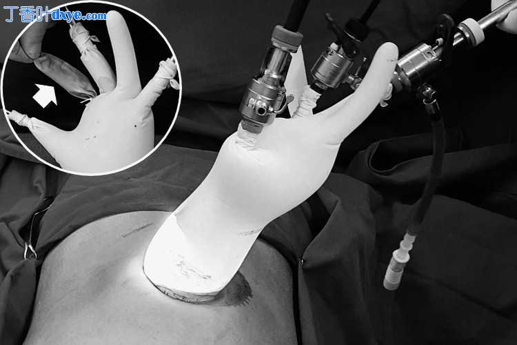 通过脐切口使用手术手套端口进行腹腔镜阑尾切除术：一项单中心回顾性研究