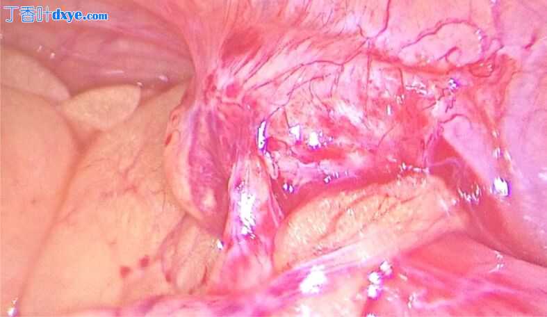 一例罕见的完全内位与乙状结肠憩室炎和阑尾发育不全有关。胚胎学，临床考虑和文献回顾