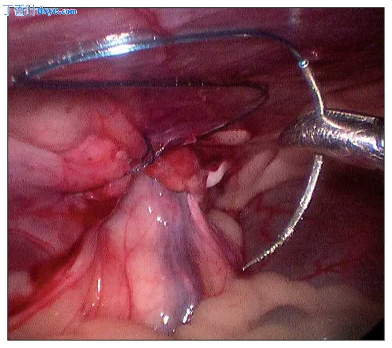 腹腔镜腹股沟疝修补术中带倒刺缝线